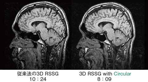 図8　頭部における従来法の3D RSSG＊とCircular計測時の3D RSSG（T1強調画像） ＊RSSG：RF Spoiled Steady State Acquisition with Rewound Gradient Echo