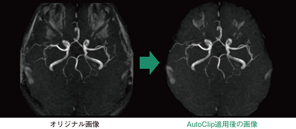 図11　AutoClip MRA画像において不要領域のクリッピング処理をサポートする。