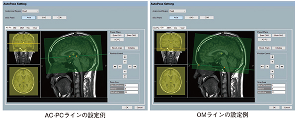 図2　AutoPose Brainのプリセット画面 専用の位置決め画像を解析し，本撮像の撮像位置を自動設定する。基準スライス位置を施設の運用に合わせて設定することができ，操作者は提示された撮像位置を確認し，必要に応じて修正することができる。