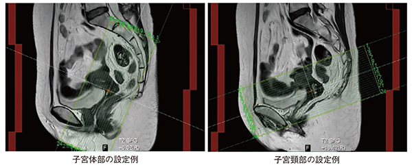 図3　女性骨盤AutoPose 3D位置決め画像およびT2強調画像を用いて撮像位置設定を支援する。操作者は提示された撮像位置を確認し，必要に応じて修正することができる。