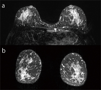 図1　H-sinc併用3D T2強調画像 a：元画像 b：MPR画像 1.1mm×1.1mm×2（1）mm reso，164slice，3min4s