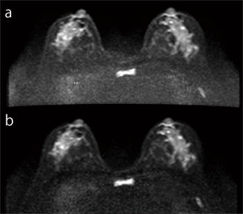 図2　H-sinc併用DWI （b1000s/mm2） a：絶対値加算画像 b：複素加算画像 2.7mm×2.0mm×5mm reso，28slice，2min31s