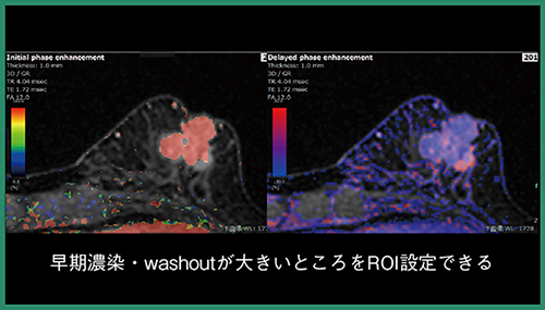図5　SYNAPSE VINCENT乳腺解析ソフト