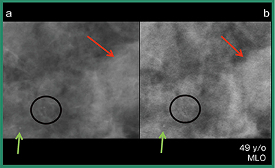 図4　図3の拡大画像 a：FFDM　b：合成2D（HRモード） bでは囊胞（↓）辺縁まで描出されている。↑と○は石灰化