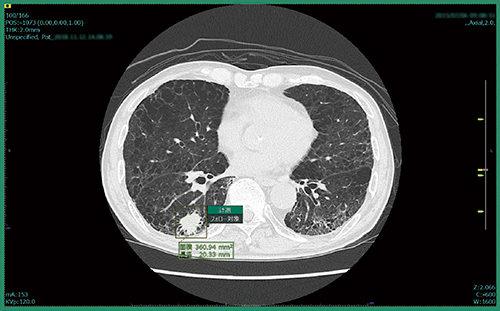 図1　肺結節CADeプロトタイプの結果表示