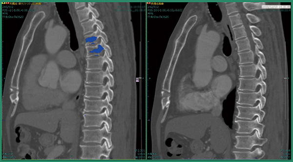 図2　症例1：改良版ソフトウエアによる骨転移候補の検出