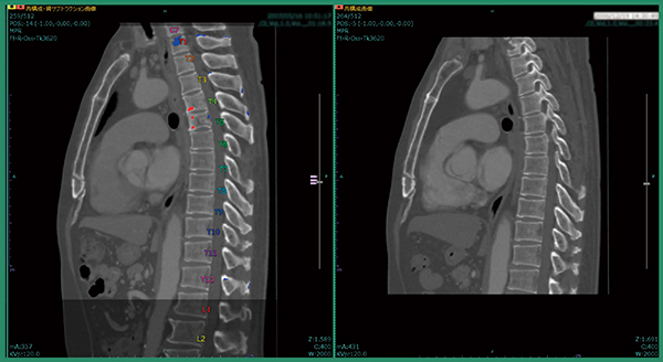 図4　症例1：T1の微小な骨転移候補の検出