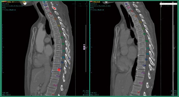 図5　症例2：T10とC7椎弓への骨転移候補の検出