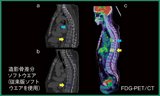 図6　症例3：造影CTの差分画像による骨転移候補の検出