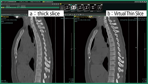 図3　Virtual Thin Slice機能 thick slice（a）では椎骨がつぶれて見えない場合でも，Virtual Thin Slice（b）では椎間板の視認性が上がっている。