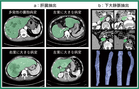 図4　肝臓・下大静脈抽出
