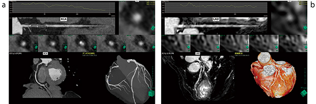 図1　CT，MR画像から自動で心臓，冠動脈を抽出した画像例