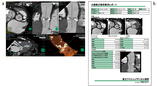 図5　大動脈弁解析の操作画面（a），およびレポート出力例（b）