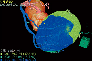 図6　主要3枝の灌流領域を計算した画像例