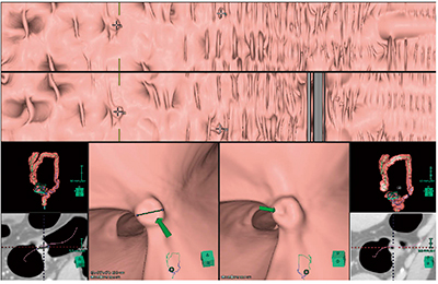 図1　大腸の解析画面