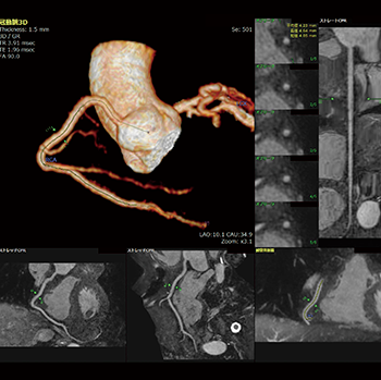 図4　冠動脈解析（MR）で主要3血管を抽出した画像例