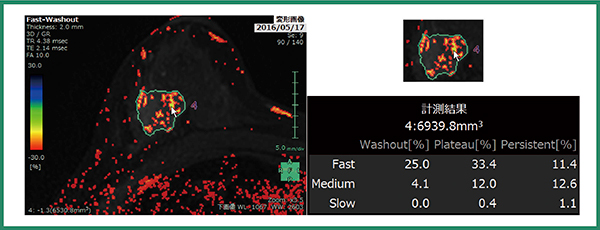 図6　乳腺解析の腫瘍抽出例