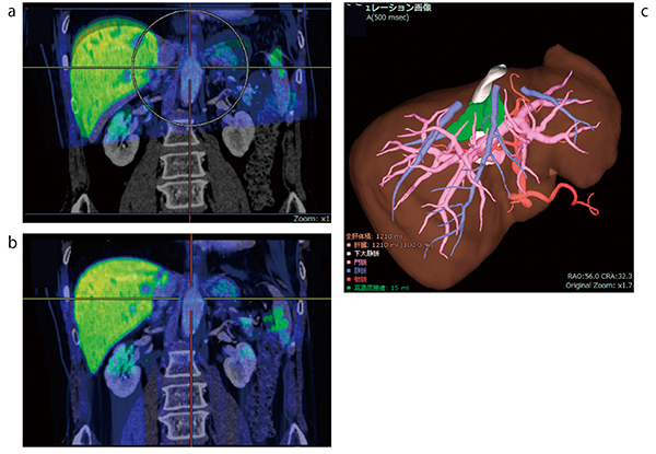 図1　造影CTと造影MRIの非剛体位置合わせ例 a：剛体位置合わせ例。呼吸相の違いにより肝臓領域の変形があるため位置ズレが生じる。 b：非剛体位置合わせ例。CTの肝臓の画像情報を基にMRIを変形させる。 c：非剛体位置合わせを行った後の支援画像。緑色はEOB造影MRIから抽出した腫瘍領域。