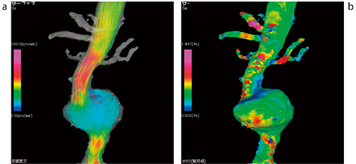 図4　4Dフロー画面例 a：流速表示例。作成した血管領域のモデルに対し，3方向の位相画像から流れおよび 速度情報を合成する。解析アプリケーション上では時間軸方向へのシネ再生が可能である。 b：wall shear stress画像例。血管壁にかかる圧力を数値化し，色分け表示する。