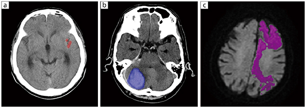 図2　脳卒中のAI技術の例 a：クモ膜下出血，b：脳内出血，c：脳梗塞