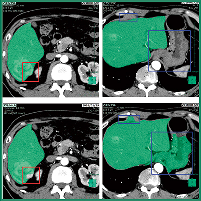 図3　自動抽出された肝臓領域（緑色） 赤枠，青枠は用いた手法の違いにより差異が出た領域 上段：ディープラーニングを用いて設計した肝臓領域抽出の結果画像例 下段：従来の肝臓抽出エンジンの結果画像例