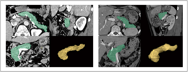 図2　膵臓抽出の画像例 膵臓は形状が複雑であり，周囲に同じような輝度値を持つ臓器が隣接しているが，ディープラーニングを用いて設計した膵臓抽出機能により，膵臓を膵臓領域として認識する。