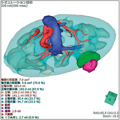 図4　腎臓ダイナミック造影CT画像から腎臓，動静脈を自動抽出したシミュレーション画像 適切に脈管を認識することで血管走行や病変部の位置関係を把握できる。