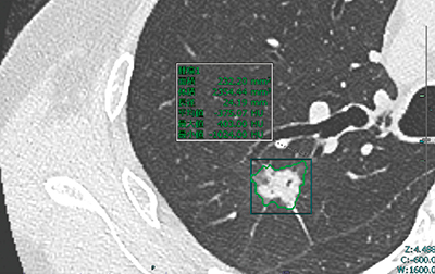 図2　SYNAPSE SAI viewerによる肺結節の検出