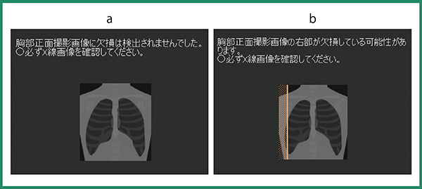 図4　胸部X線画像から，肺野欠損の推定結果を表示する画面イメージ