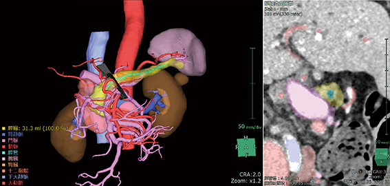 図2　膵臓三次元画像と門脈左縁切除時のCT断面
