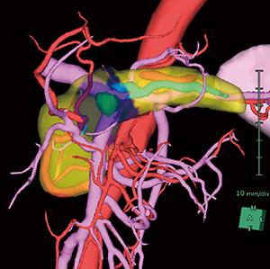 図3　腫瘍マージン表示機能