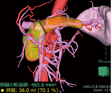 図4　膵臓ボリューム計測
