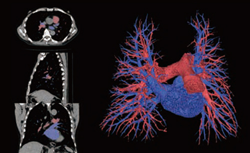 図3　単純CTを用いた肺動静脈分離（肺切除解析）