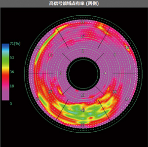 図4　遅延造影CTにおける高信号領域占有率
