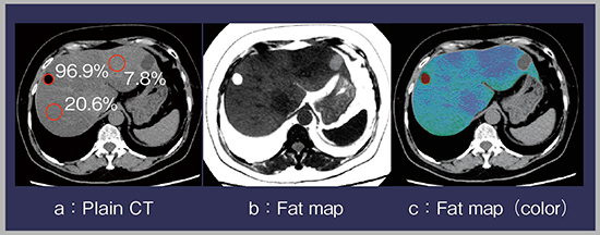 図4　肝臓の脂肪定量アプリケーションGSI Liver Fat