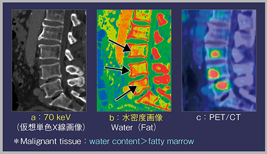 図6　症例5：肺がんからの多発骨転移