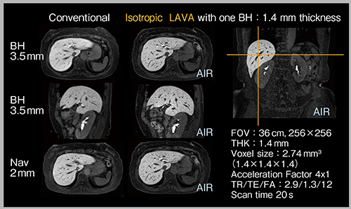 図2　AIR AAを用いた息止めによる乏血性低信号結節の描出