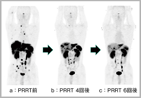 図3　症例2（30歳代，男性）：多発転移を伴う膵神経内分泌腫瘍に対するPRRT後の変化