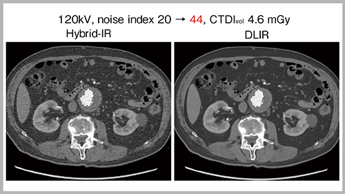 図1　低線量CT（80％減）におけるDLIRの有効性