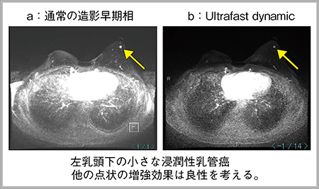 図1　Ultrafast Breast MRIの自験例