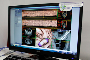 CTコロノグラフィの読影をアシストするDigital Contrast Agent
