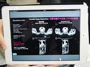 「Revolution EVO」が可能にした“Double Dose Reduction”
