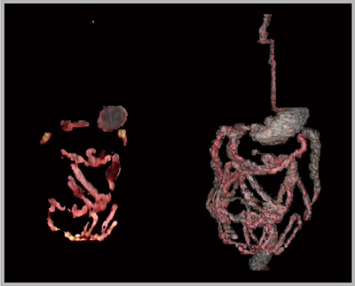 図5　消化管のPET/MRI融合画像