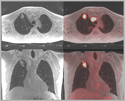 図7　肺がんのPET/MRI融合画像（W.I.P.）