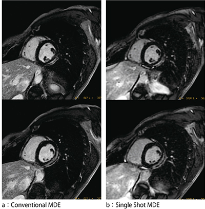 図3　Conventional MDEとSingle Shot MDEによる心筋遅延造影画像の比較