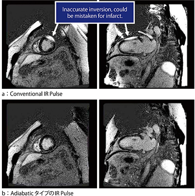 図4　Conventional IR PulseとAdiabaticタイプのIR Pulseによる心筋遅延造影画像の比較