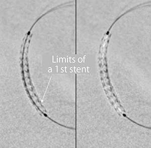 図4　StentViz　右にワイヤをサブトラクションした画像を並行表示