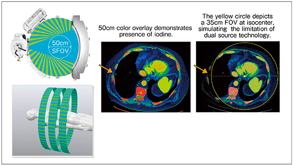 図1　Fast kVp switching方式デュアルエナジーGSI Xtream 50cm FOVの撮影により，大柄な患者のFOV辺縁部の領域に関しても問題なくdual energy撮影が可能（左）。右図は，アイソセンタから35cmの範囲のみカラー表示をしており，肺野の病変がカバーできていないことが確認できる。