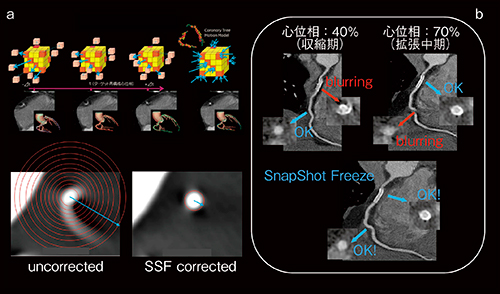 図2　SnapShot Freeze 起始部と末端部で最適心位相が異なるようなケースでも1心位相で静止画像が得られた例。モーション抑制だけでなく，解析時間短縮・ワークフロー向上にも寄与。