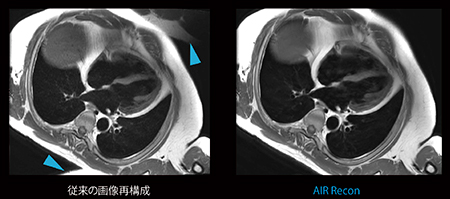 図3　AIR Reconと従来画像再構成法による画像比較（同一のraw dataを使用） AIR Reconにより，腹壁と上肢の折り返しアーチファクトが低減している（◀）。